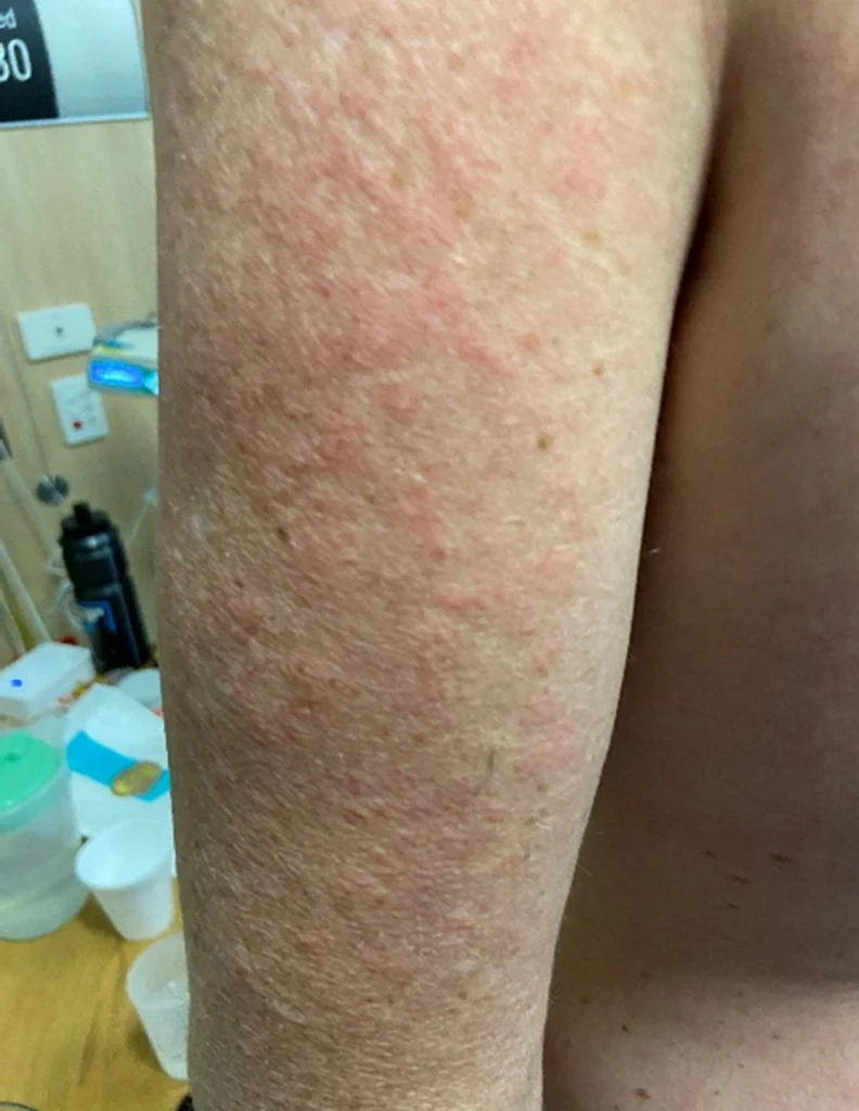 Adult Stills Sjukdom