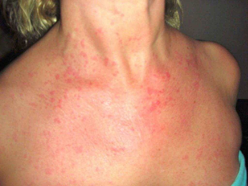 Adult Stills Sjukdom